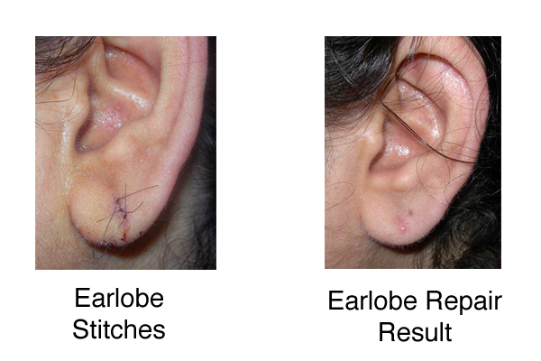 Ear Lobe Repair Dr Nina Madnani